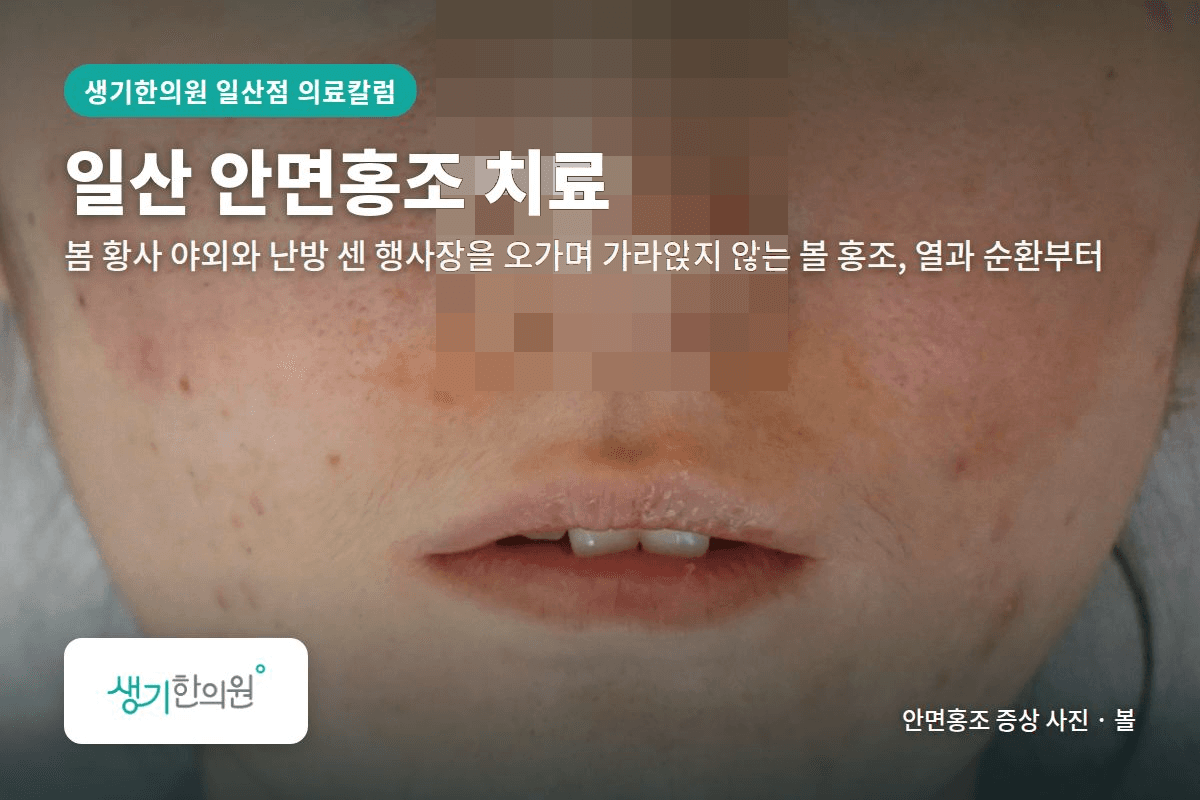 볼 안면홍조 증상 사진과 문구 「일산 안면홍조 치료, 봄 황사 야외와 난방 센 행사장을 오가며 가라앉지 않는 볼 홍조, 열과 순환부터 · 생기한의원 일산점」