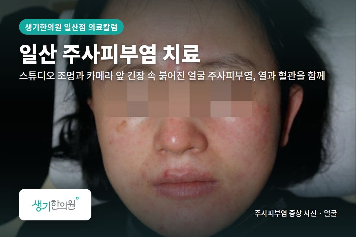 얼굴 주사피부염 증상 사진과 문구 「일산 주사피부염 치료, 스튜디오 조명과 카메라 앞 긴장 속 붉어진 얼굴 주사피부염, 열과 혈관을 함께 · 생기한의원 일산점」