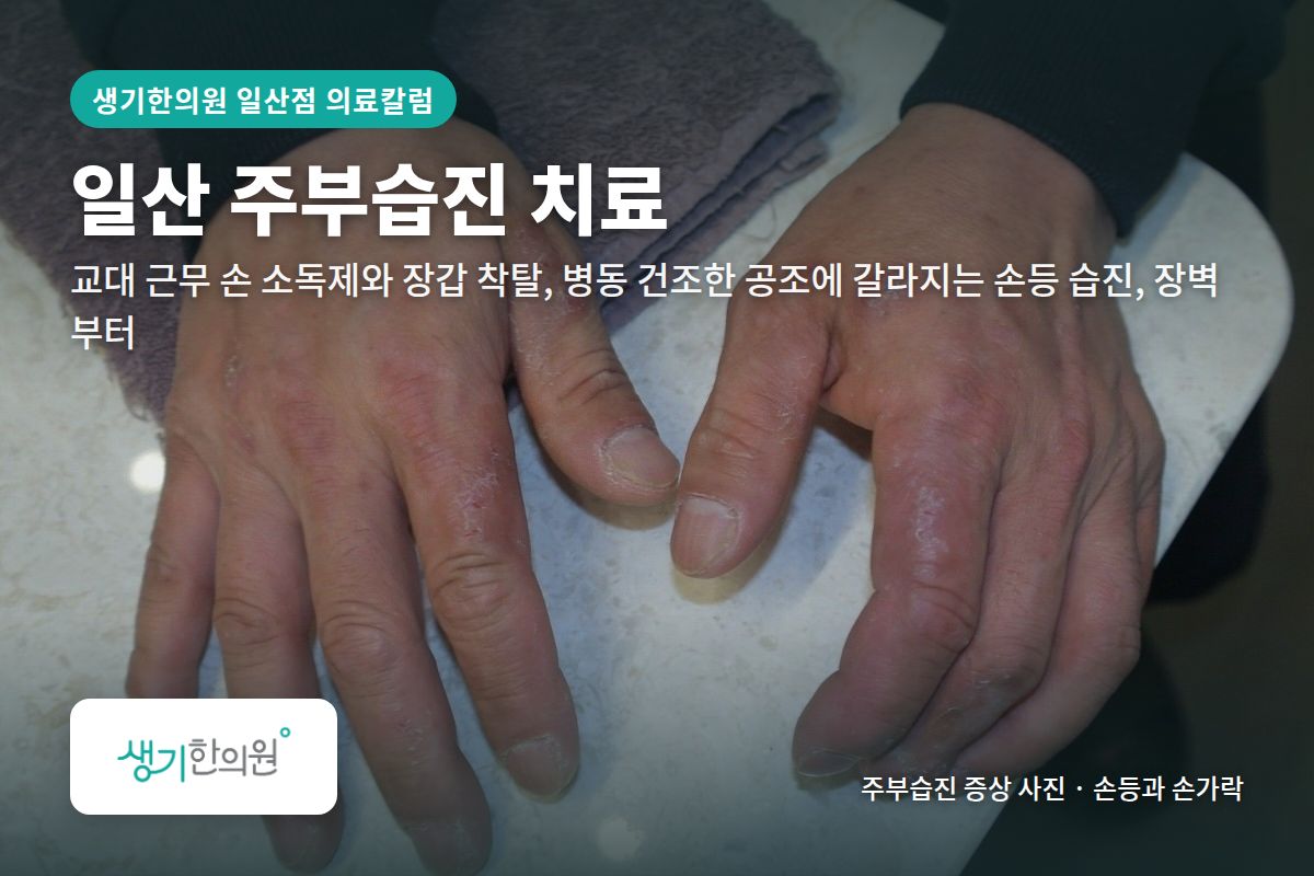 손등과 손가락 주부습진 증상 사진과 문구 「일산 주부습진 치료, 교대 근무 손 소독제와 장갑 착탈, 병동 건조한 공조에 갈라지는 손등 습진, 장벽부터 · 생기한의원 일산점」